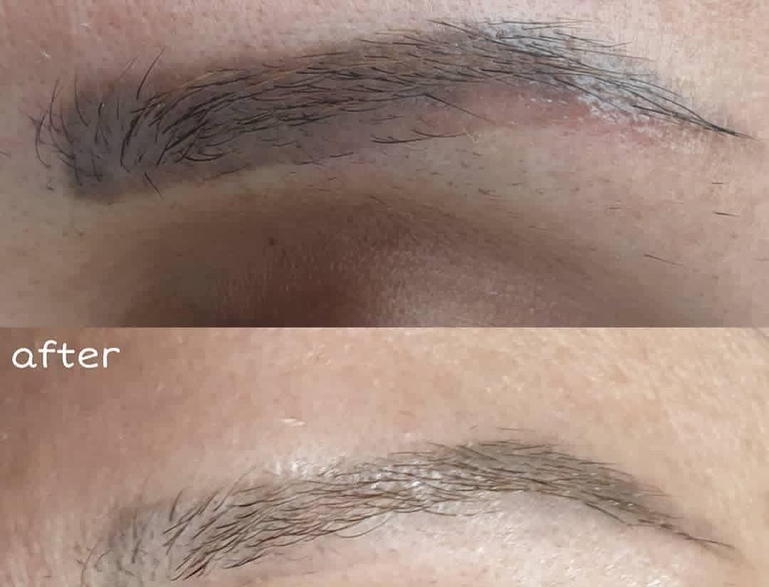 ۴۰٪ تخفیف پاک کردن تتو و خالکوبی با لیزرQ-switch|خدمات آرایشگری و زیبایی|کرمانشاه, |دیوار