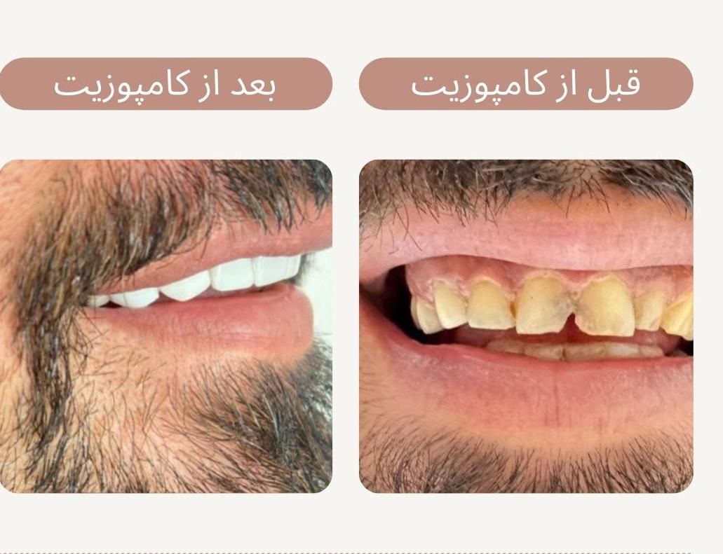 خدمات زیبایی دندان|خدمات آرایشگری و زیبایی|مشکین‌دشت, |دیوار