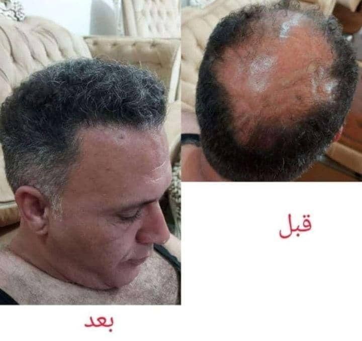 کاشت مو و ابرو|آرایشگاه و سالن‌های زیبایی|تهران, جردن|دیوار