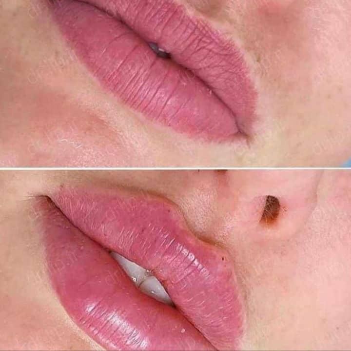ژل لب بوتاکس پی آر پی آنزیم لیزر مو هایفو فشیال|خدمات آرایشگری و زیبایی|کرج, گوهردشت|دیوار
