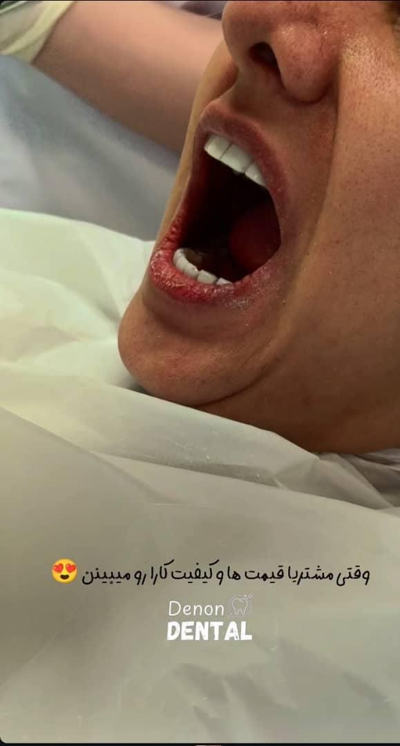 دندانپزشکی خیریه کامپوزیت 600 ، ایمپلنت با روکش 9|خدمات آرایشگری و زیبایی|تهران, تجریش|دیوار