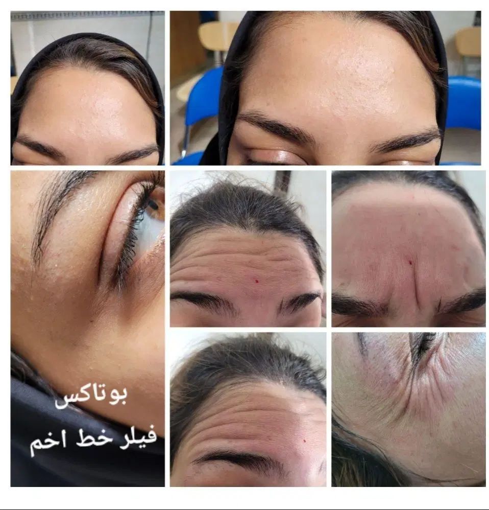 مدل برای تزریق فیلر،بوتاکس،مزو،آنزیم تحت نظر پزشک|خدمات آرایشگری و زیبایی|مشهد, آزادشهر|دیوار