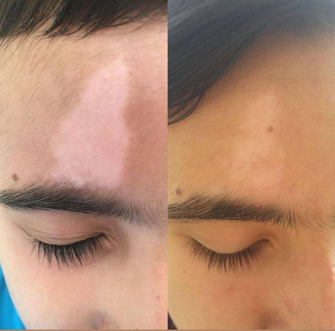 درمان تضمینی پیسی و پسوریازیس|خدمات آرایشگری و زیبایی|مشهد, انقلاب|دیوار