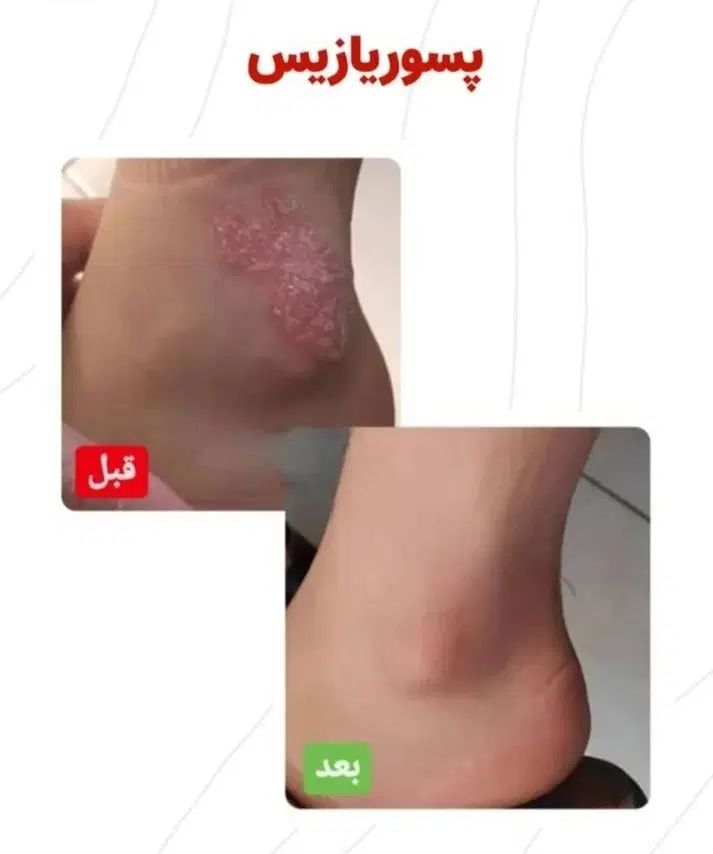 درمان پسوریازیس یا صدفک با گیاهان درمانی|آرایشی، بهداشتی، درمانی|اهواز, دانشگاه چمران|دیوار
