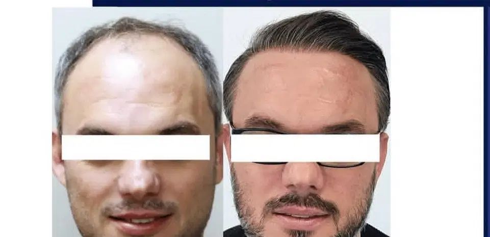 کاشت مو و ابرو طبیعی|خدمات آرایشگری و زیبایی|اصفهان, شاهزید|دیوار