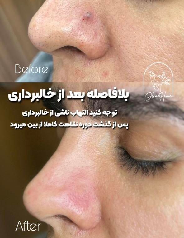 برداشت انواع خال صورت و بدن|خدمات آرایشگری و زیبایی|اهواز, کیانپارس |دیوار