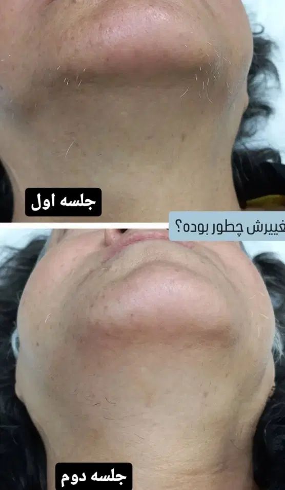 الکترولیز روشی قطعی حذف موهای زائد صورت|خدمات آرایشگری و زیبایی|اشنویه, |دیوار