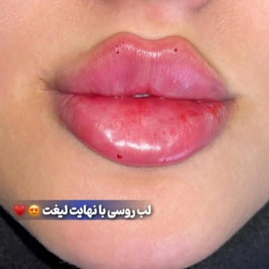 تزریق ژل بوتاکس وانزیم فیلر بینی ۳۹۹|خدمات آرایشگری و زیبایی|تهران, عبدل‌آباد|دیوار