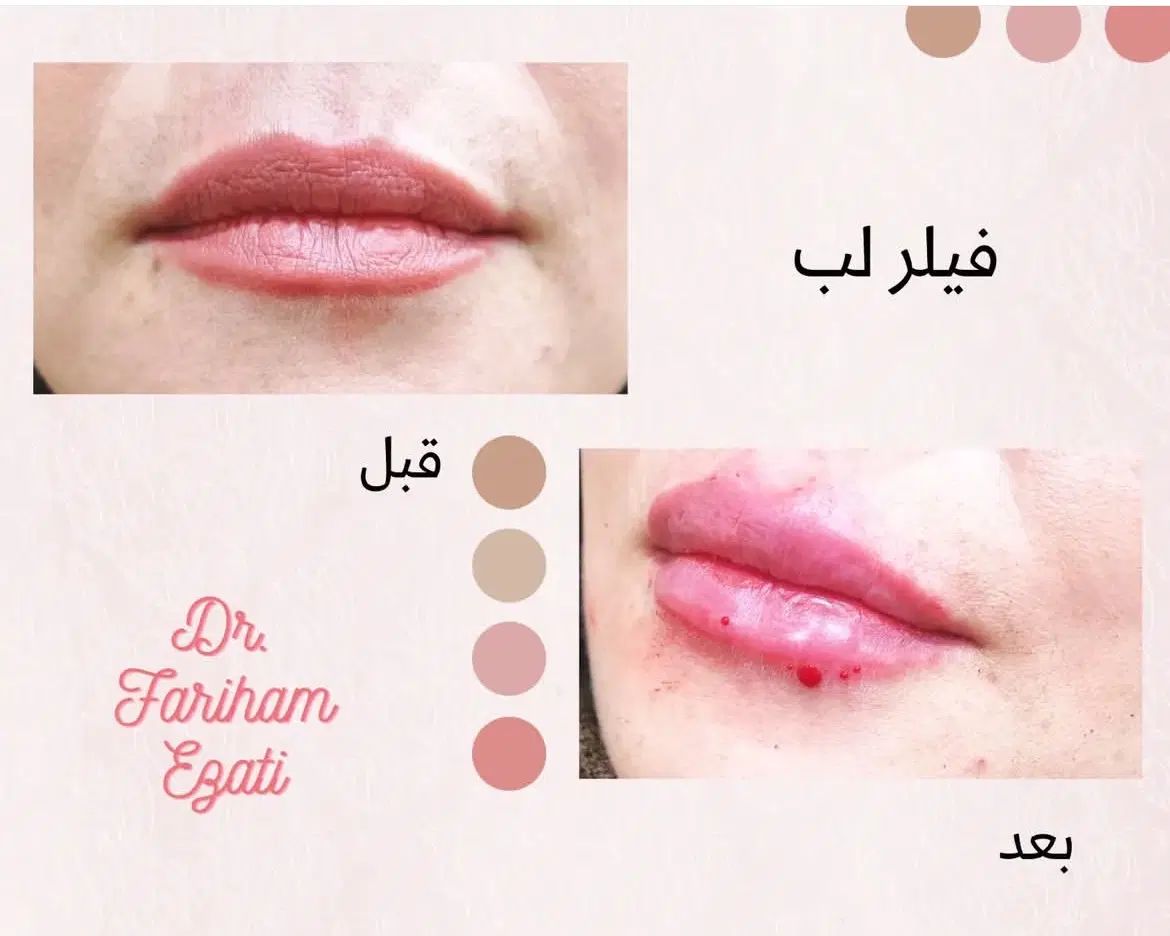 فیلر، بوتاکس، جوانساز|خدمات آرایشگری و زیبایی|تهران, کوی بیمه|دیوار