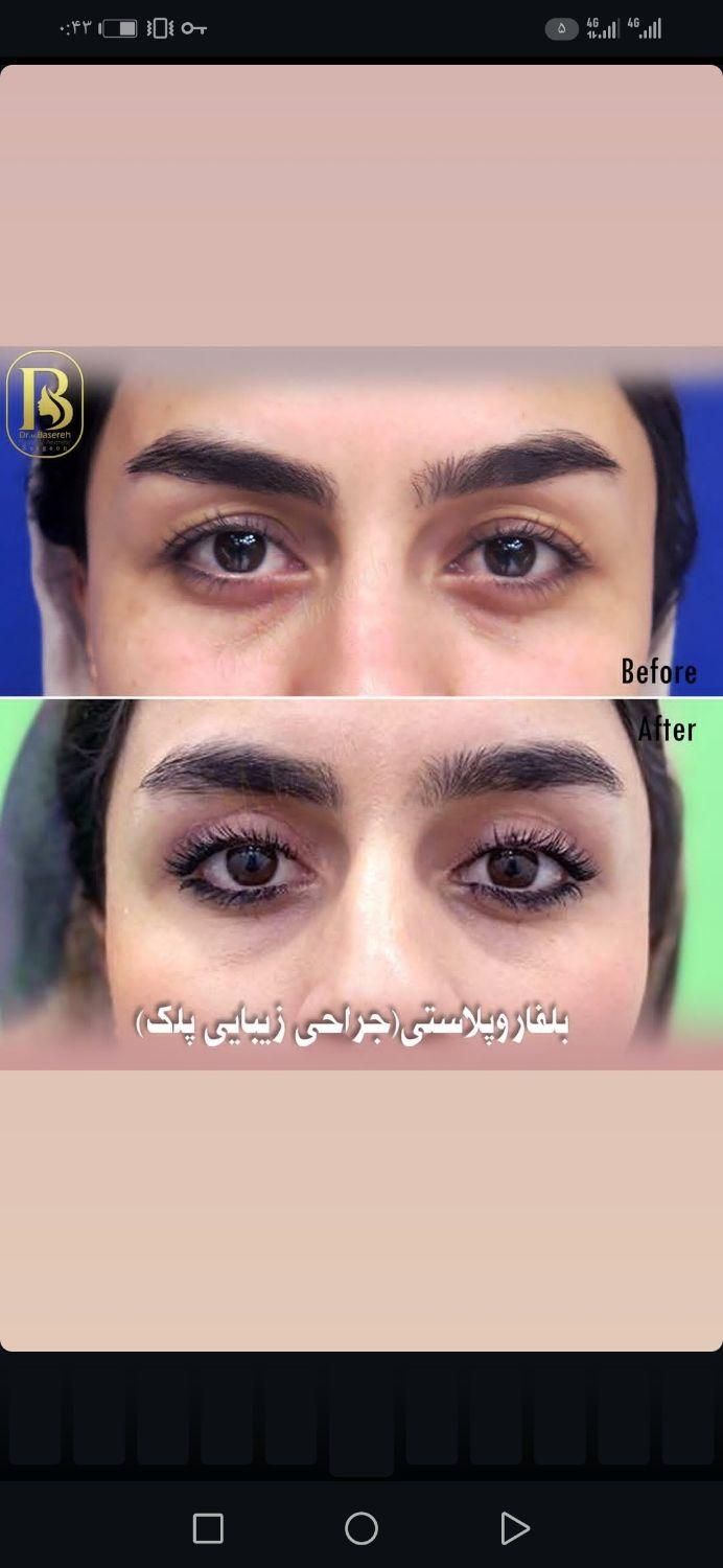 عمل. تزریق چربی صورت بیکینی لابیا پلاستی و بوتاکس|خدمات آرایشگری و زیبایی|رشت, جهاد|دیوار