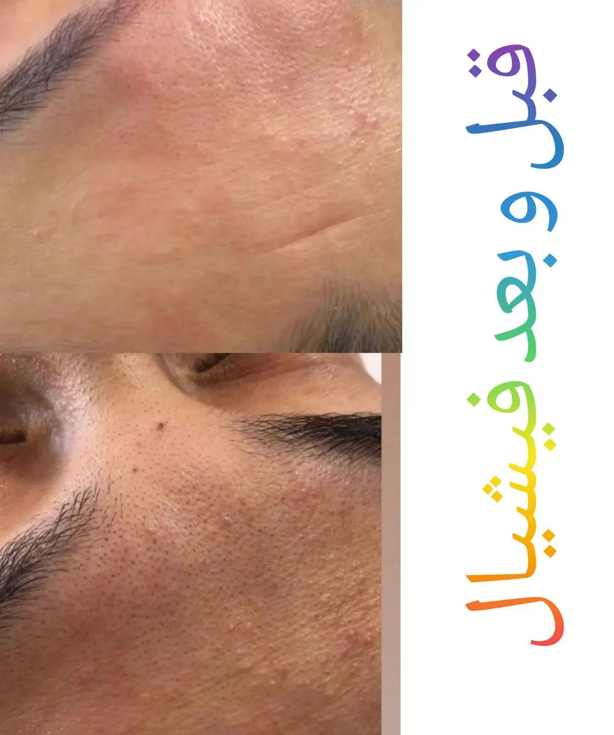 تخفیفات ویژه خدمات آموزش فشیال اکستنشن هیدن لیفت|خدمات آرایشگری و زیبایی|قرچک, میرزائی شمالی|دیوار