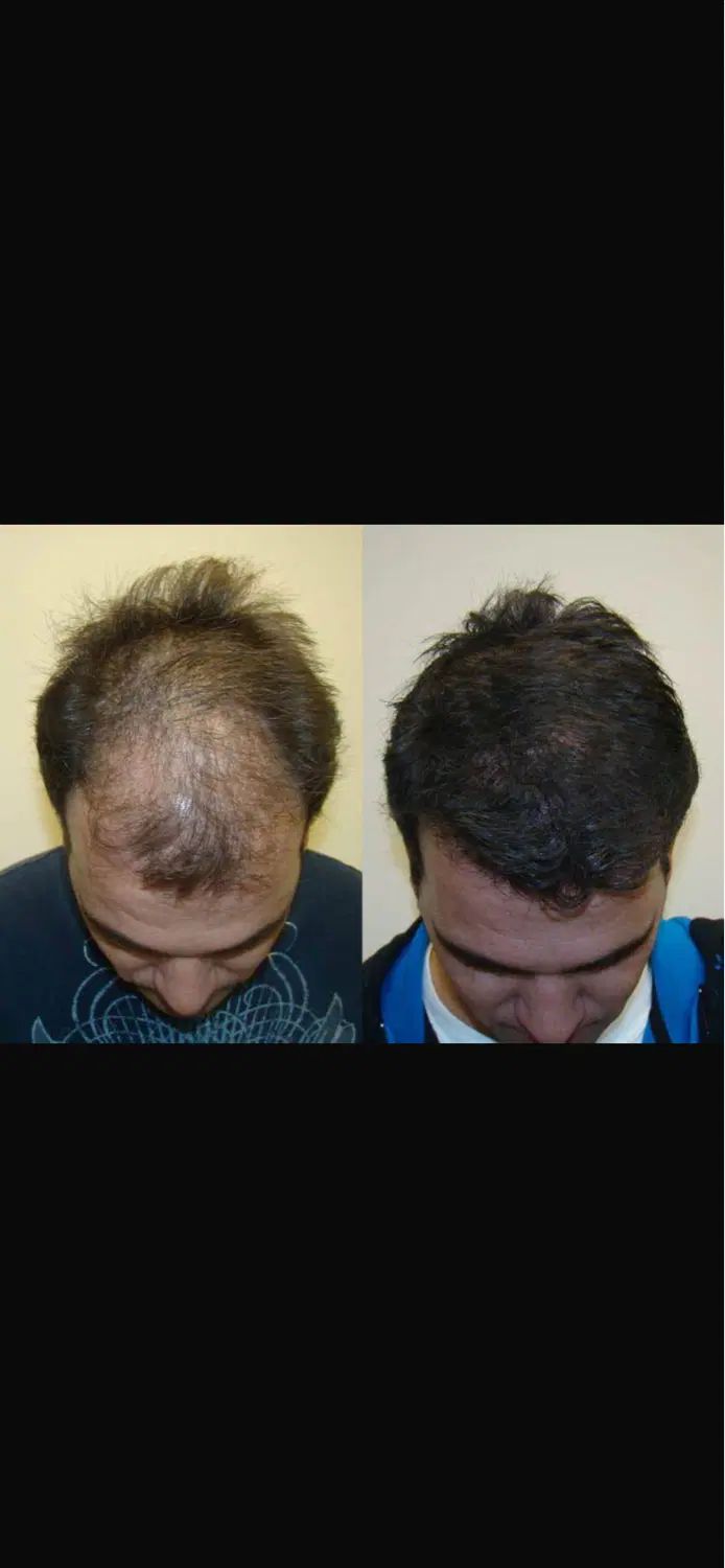 درمان ریشه ای مشکلات مو‌  با ضمانت عودت وجه|خدمات آرایشگری و زیبایی|قزوین, |دیوار
