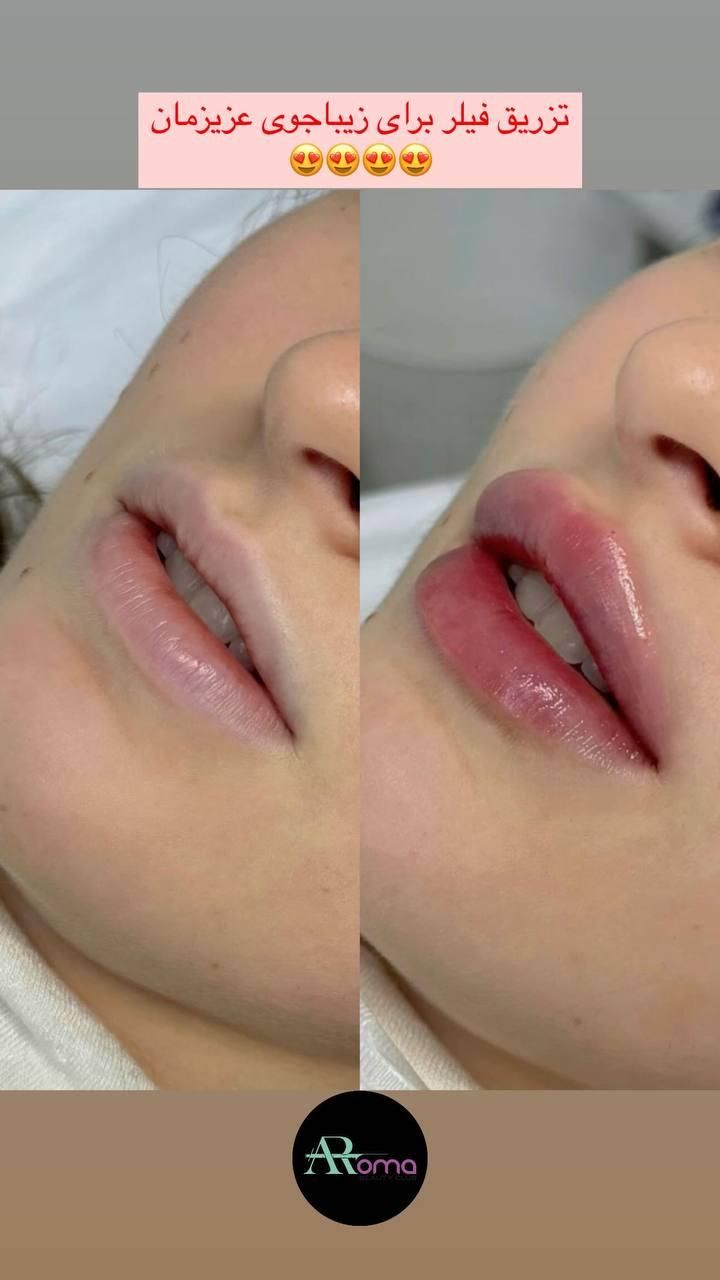 جشنواره تزریق ژل فیلر و بوتاکس و پی آر پی ( PRP )|خدمات آرایشگری و زیبایی|تهران, جنت‌آباد جنوبی|دیوار