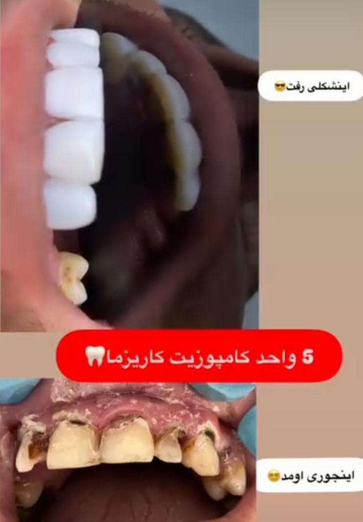 آموزش زیبایی دندانپزشکی .کامپوزیت وبلیچینگ .اقساطی|خدمات آموزشی|بابل, |دیوار