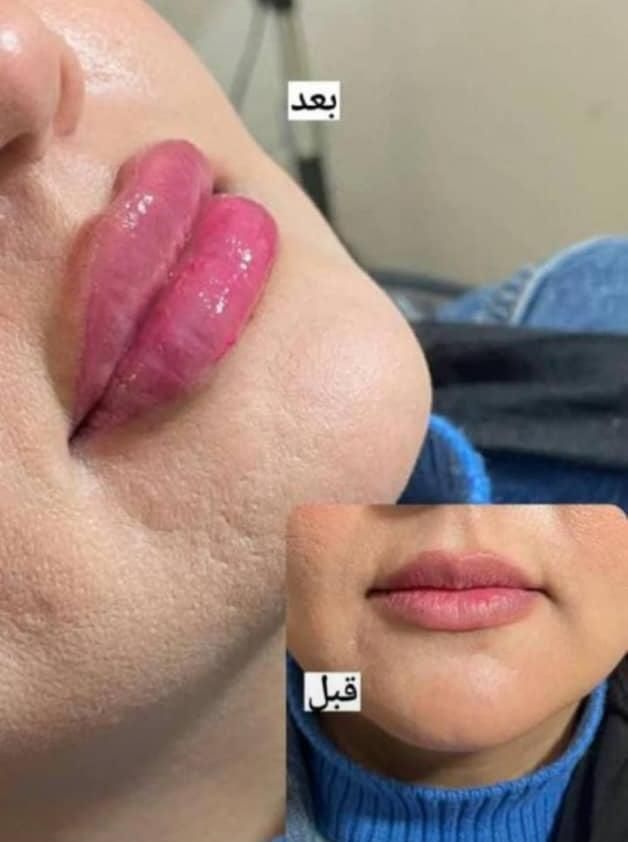 آموزش ژل،بوتاکس،لیفت،فیلربادی،انواع مزو مو و پوست|خدمات آموزشی|شهریار, شهرک وائین|دیوار