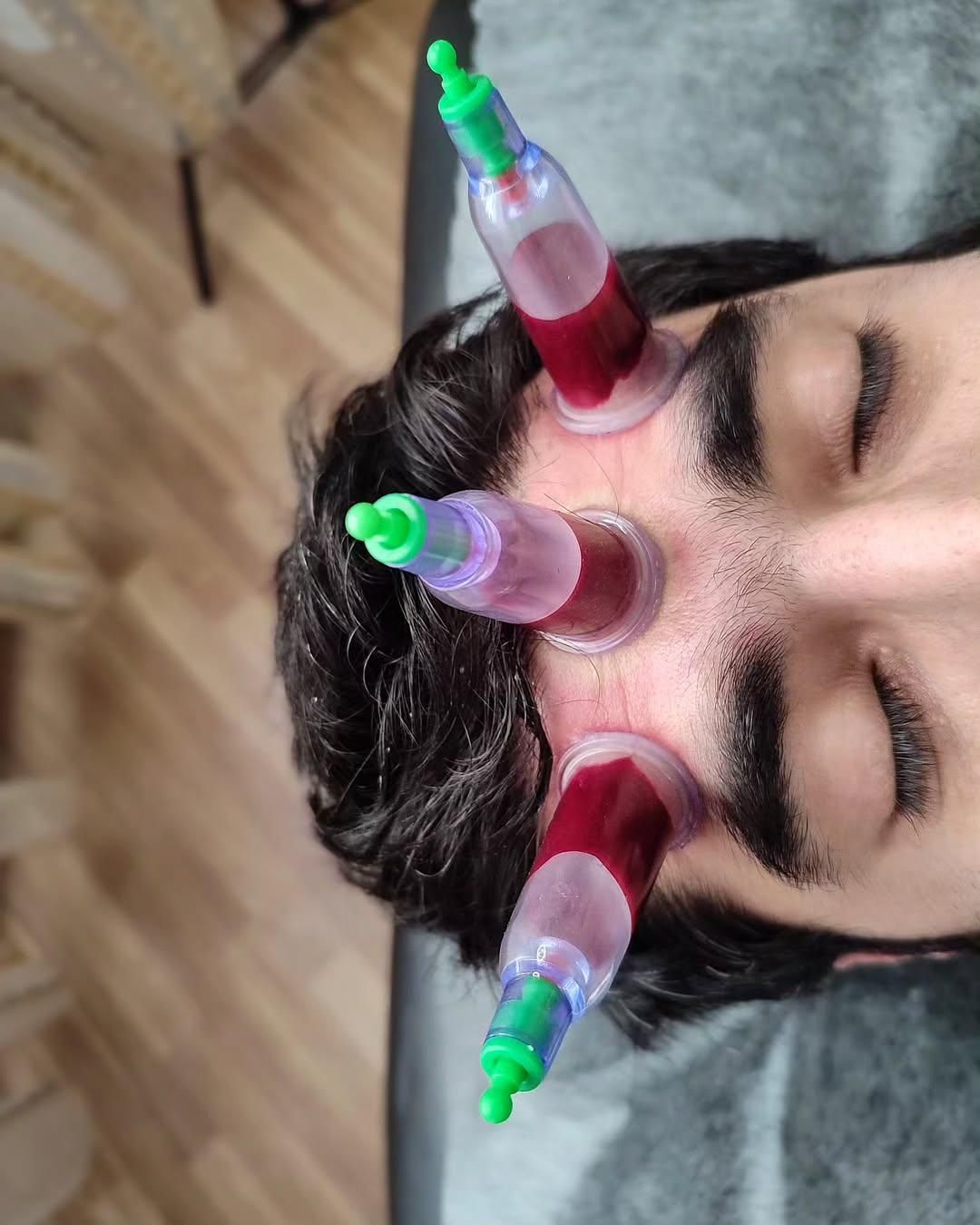 حجامت، درمان چسبندگی عصب دست، کبد چرب|خدمات آرایشگری و زیبایی|زاهدان, |دیوار