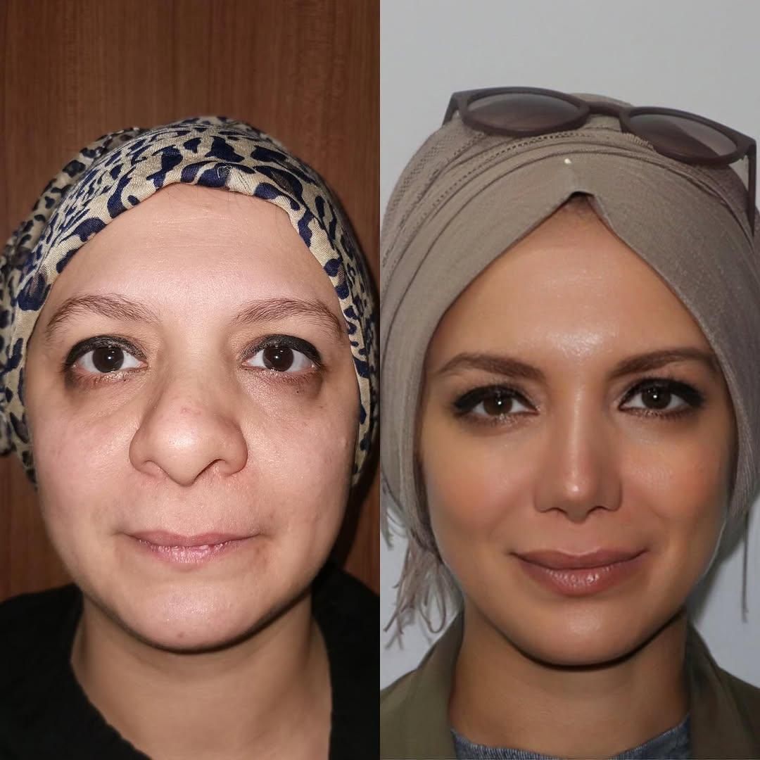 جراحی عمل بینی ۲۴ میلیونی/رینوپلاستی/بینی فانتزی|خدمات آرایشگری و زیبایی|تهران, مطهری|دیوار