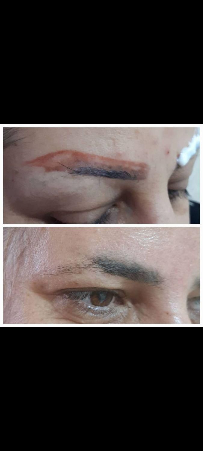 پاک کردن تتو صورت و بدن|خدمات آرایشگری و زیبایی|شاهین‌شهر, مخابرات (شهید بهشتی)|دیوار