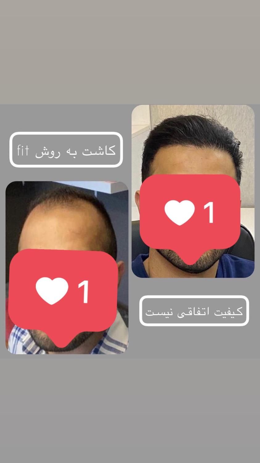 جشنواره  کاشت مو و ابرو شیراز|خدمات آرایشگری و زیبایی|اصفهان, دانشگاه اصفهان|دیوار