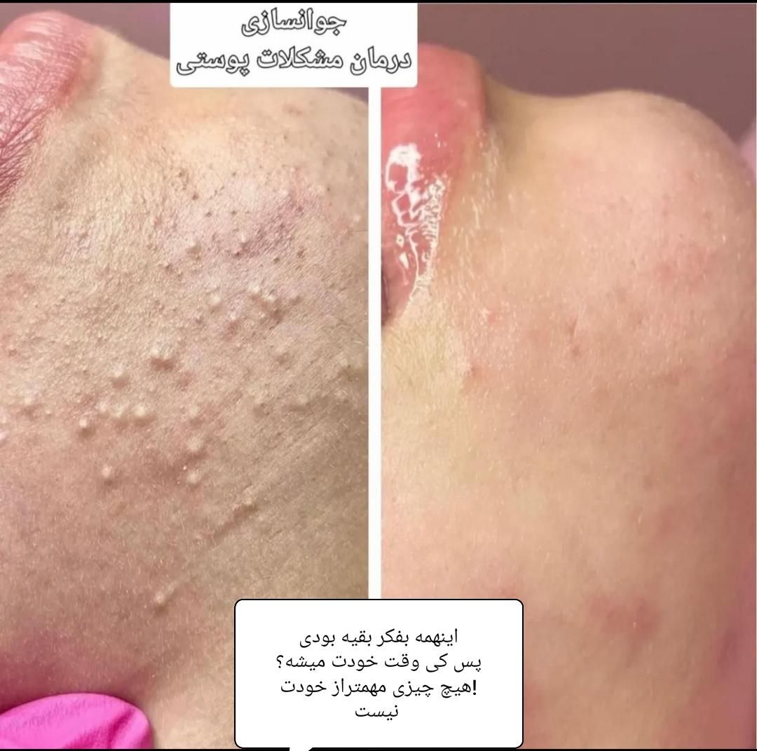 فیشیال و پاکسازی تخصصی ودرمان مشکلات پوستی(تخفیف)|خدمات آرایشگری و زیبایی|گرگان, |دیوار