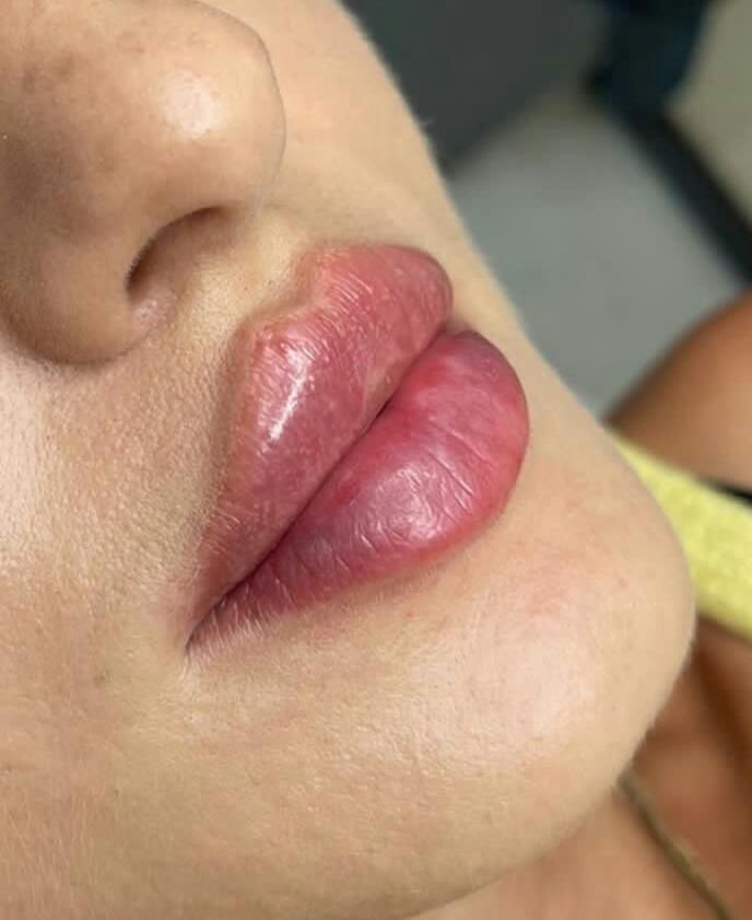 تزریق ژل لب و بوتاکس|خدمات آرایشگری و زیبایی|شیراز, شهرک سراج‎|دیوار