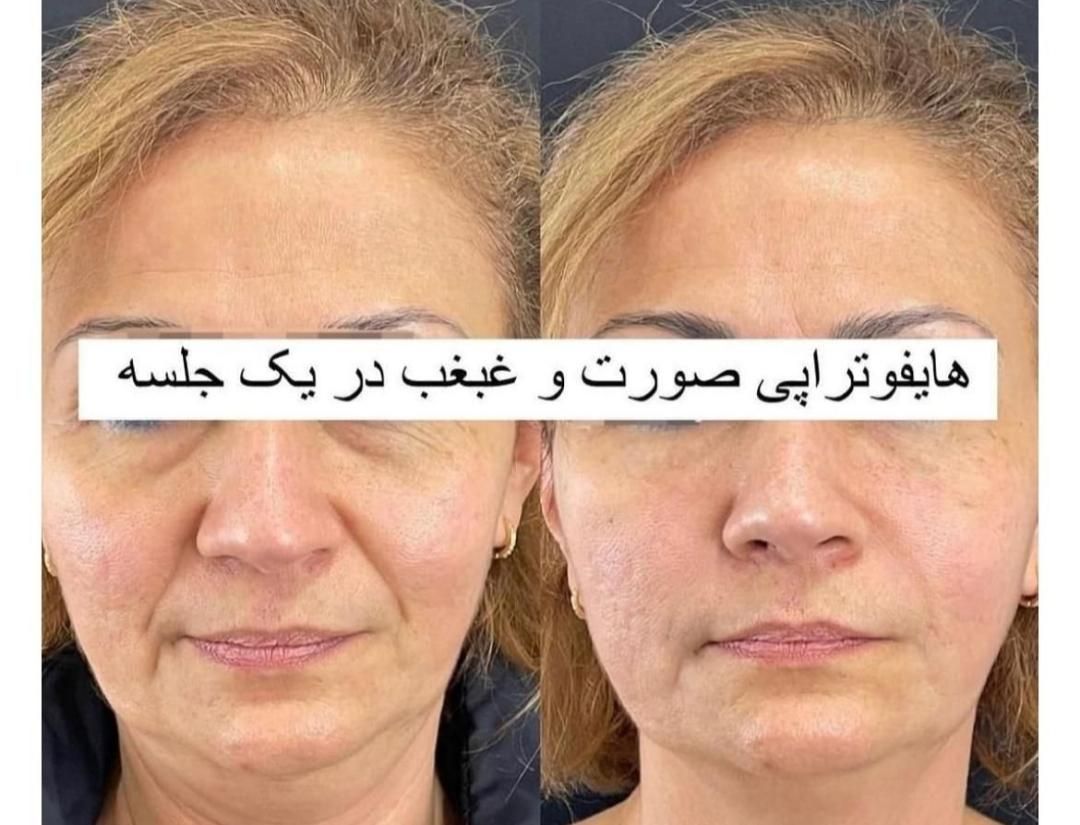 تخصص ما لیزر ژل و بوتاکس حرفه ای و جوانسازی پوست|خدمات آرایشگری و زیبایی|تهران, شهرک ولیعصر جنوبی|دیوار