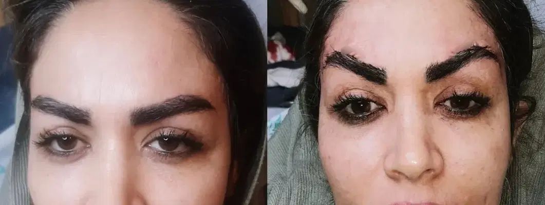 عمل لیفت ابرو و شقیقه جراحی ۸.بوتاکس مصپورت ۶۰۰|خدمات آرایشگری و زیبایی|مشهد, شهید فرامرز عباسی|دیوار