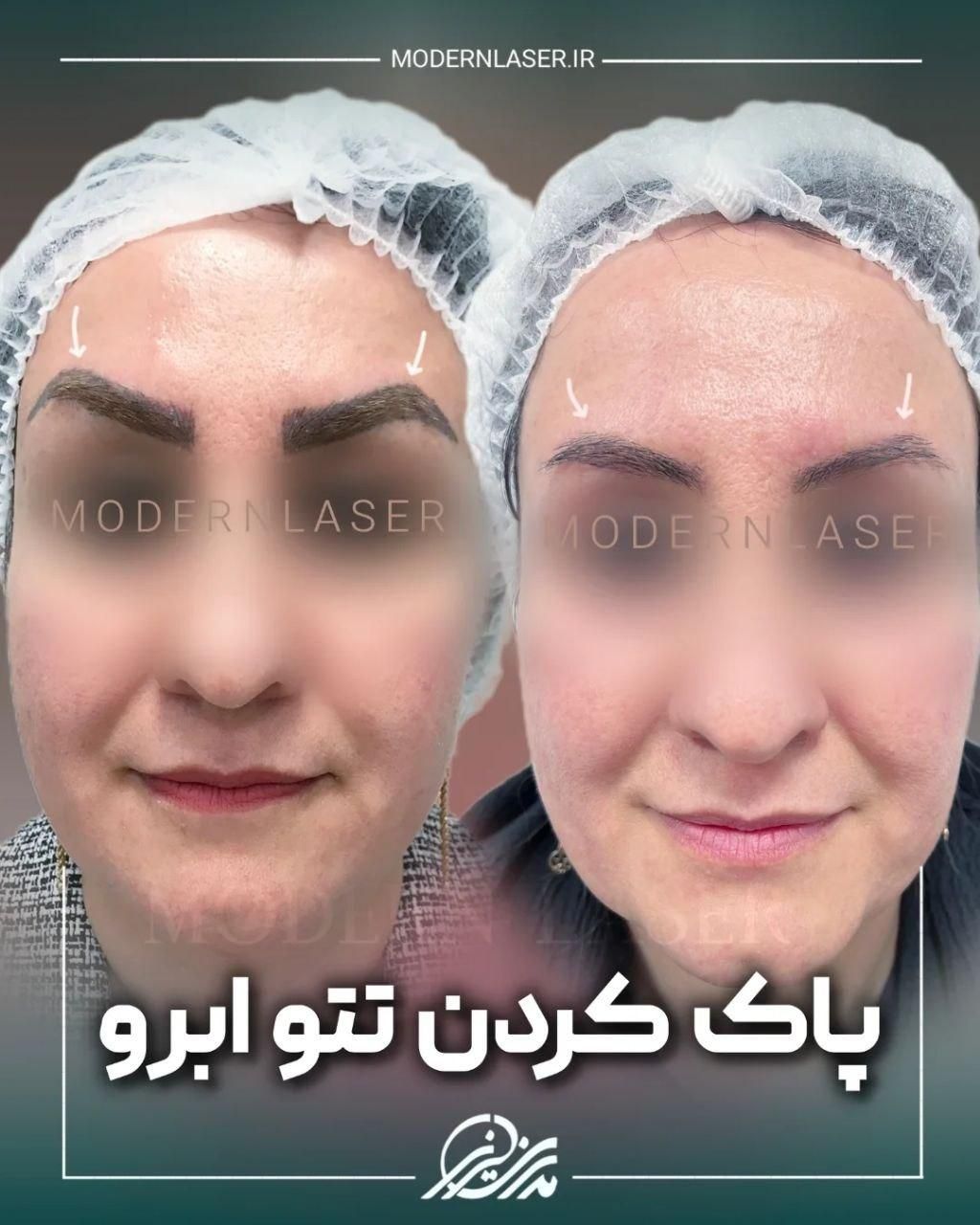 ریموو انواع تتو و خالکوبی بدون هیچ اثری توسط پزشک|خدمات آرایشگری و زیبایی|اصفهان, سعادت‌آباد|دیوار