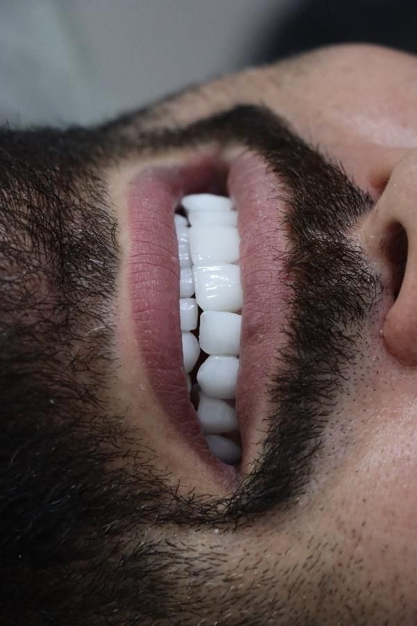 عصبکشی/کامپوزیت/کشیدن دندان|خدمات آرایشگری و زیبایی|ساری, |دیوار