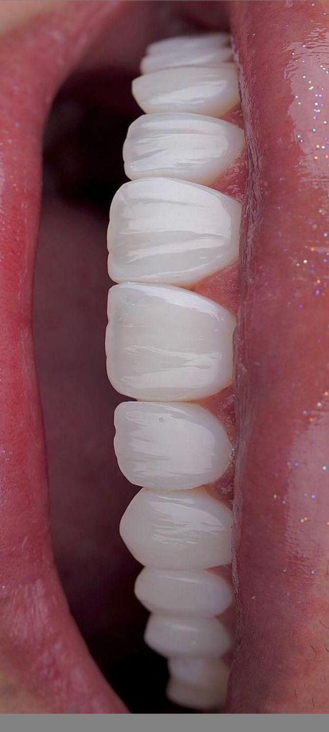 دندانپزشکی کامپوزیت عصبکشی|خدمات آرایشگری و زیبایی|نسیم‌شهر, |دیوار