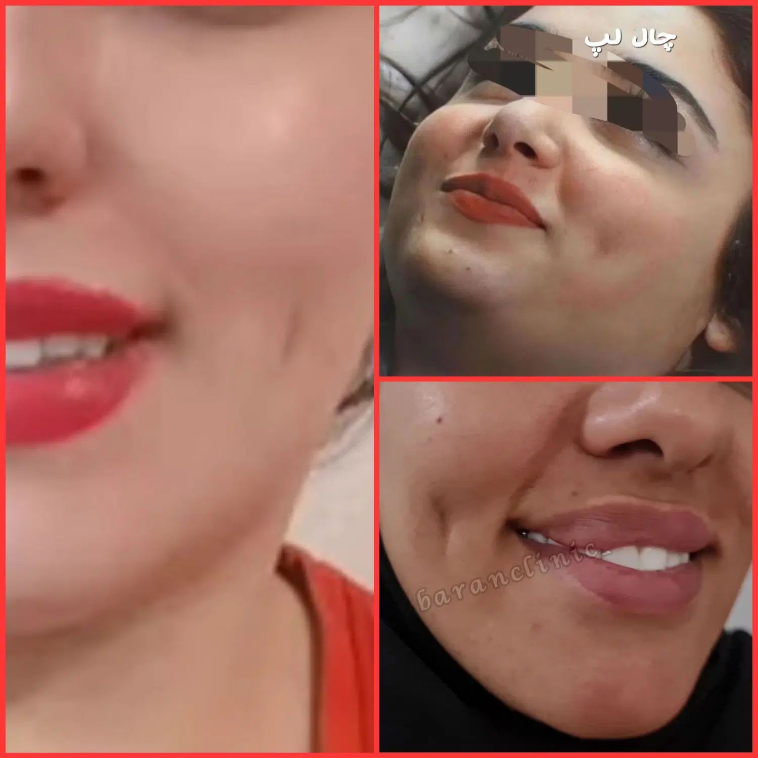 ژل بوتاکس چال لپ فیلربیکینی مزوتراپی پیرسینگ|خدمات آرایشگری و زیبایی|اسلام‌شهر, زرافشان|دیوار