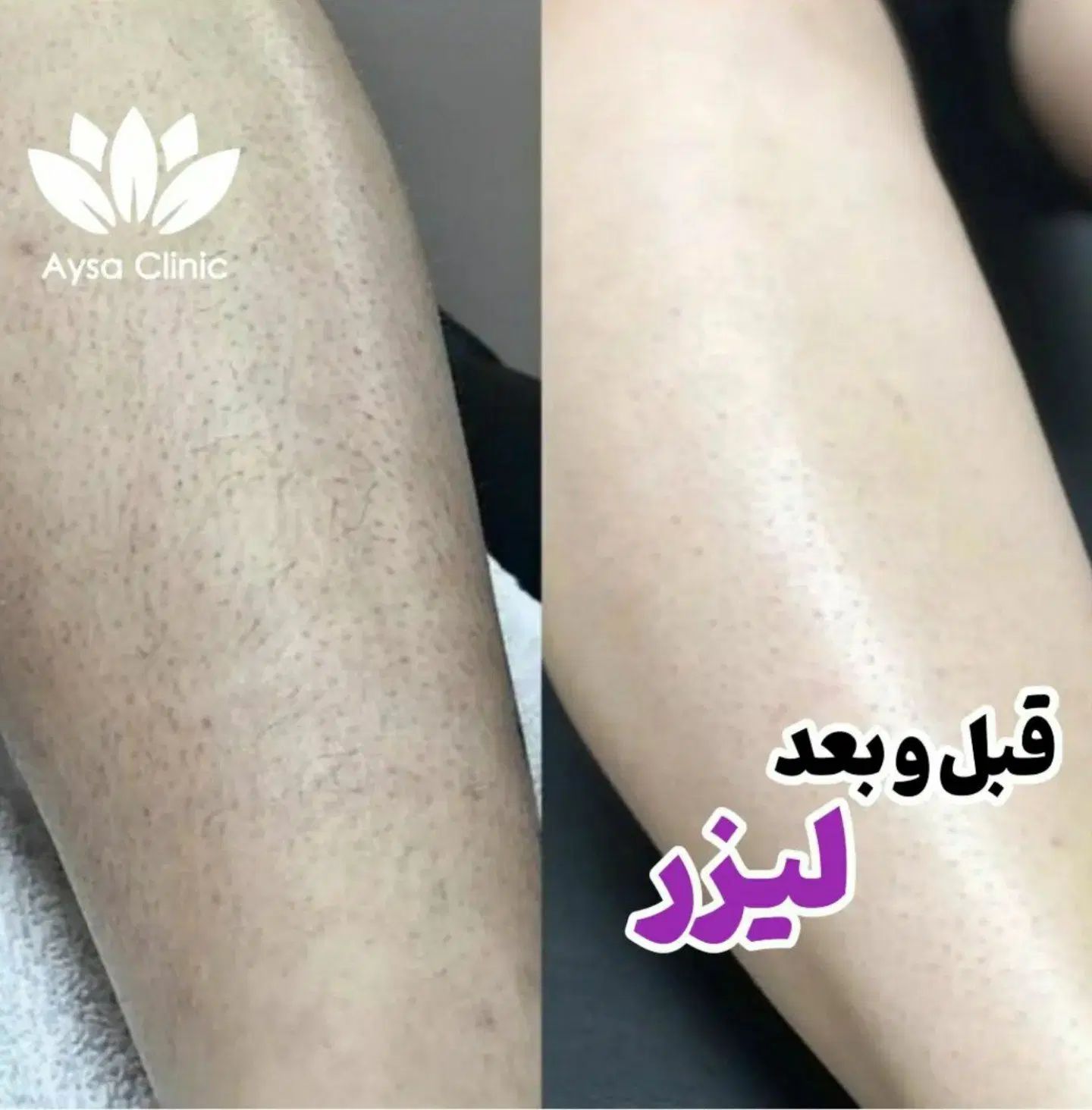 لیزر موهای زائد فول فقط ۳۹۰|خدمات آرایشگری و زیبایی|اصفهان, دوطفلان|دیوار