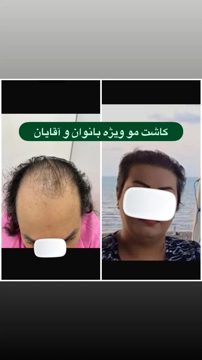 کاشت مو سوزن ۰/۷،کاشت ابرو کره ای(تیم شیراز دریزد)|خدمات آرایشگری و زیبایی|یزد, |دیوار