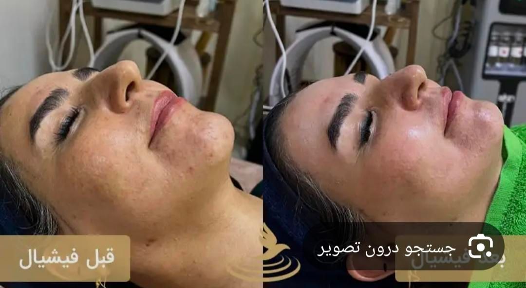 فشیال پوست وپلاژن تراپی درکلینیک با دستگاه|خدمات آرایشگری و زیبایی|کرج, کوی زنبق|دیوار