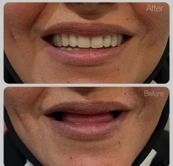 دندانساری متحرک(مصنوعی)|خدمات آرایشگری و زیبایی|اصفهان, جاوان|دیوار