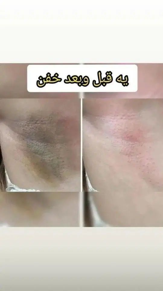 رفع تیرگی ، ناباروری،  چاقی صورت و بدن ، لاغری|آرایشی، بهداشتی، درمانی|زاهدان, |دیوار