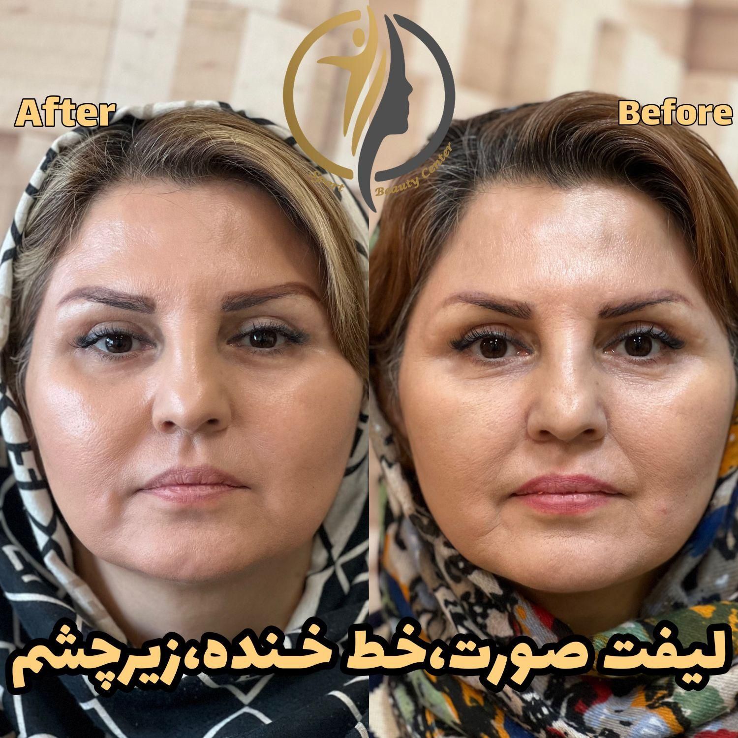 افر استثنایی خدمات زیبایی تزریق ژل و لیزر و فیشال|خدمات آرایشگری و زیبایی|تهران, سعادت‌آباد|دیوار