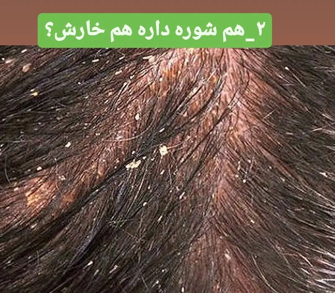 پاکسازی کف سر،درمان ریزش،شوره چربی سروضخیم سازی مو|خدمات آرایشگری و زیبایی|نیشابور, هفده شهریور|دیوار