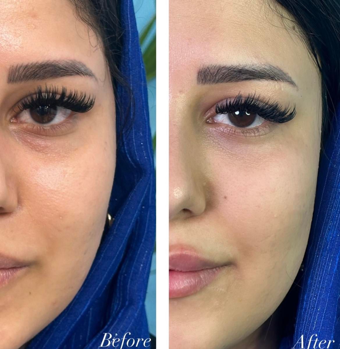 ژل لب بوتاکس فیلر انزیم کامپوزیت دندان|خدمات آرایشگری و زیبایی|مشهد, راهنمایی|دیوار