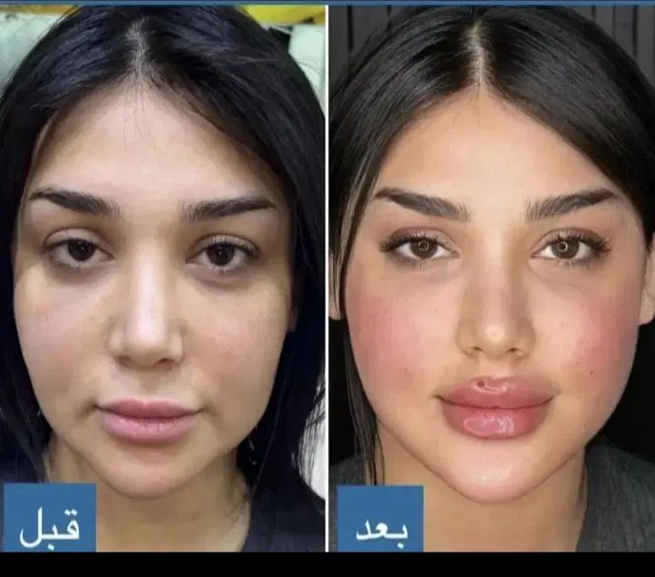 جشنواره تزریق بوتاکس وژل. فیلرکل صورت از ۷میلیون|خدمات آرایشگری و زیبایی|بردسیر, |دیوار