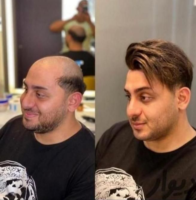 پروتز مو وارداتی ،کاشت hrt|خدمات آرایشگری و زیبایی|اصفهان, گلزار|دیوار