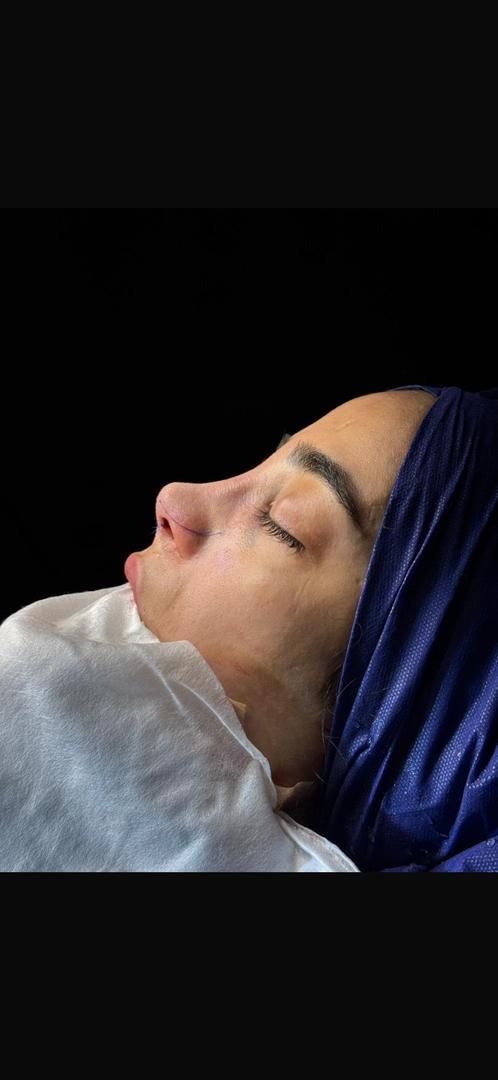 جراحی بینی ۲۴میلیون|خدمات آرایشگری و زیبایی|اسلامشهر, شهرک قائمیه|دیوار