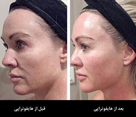 هایفوتراپی صورت و غبغب و شکم|خدمات آرایشگری و زیبایی|تبریز, |دیوار