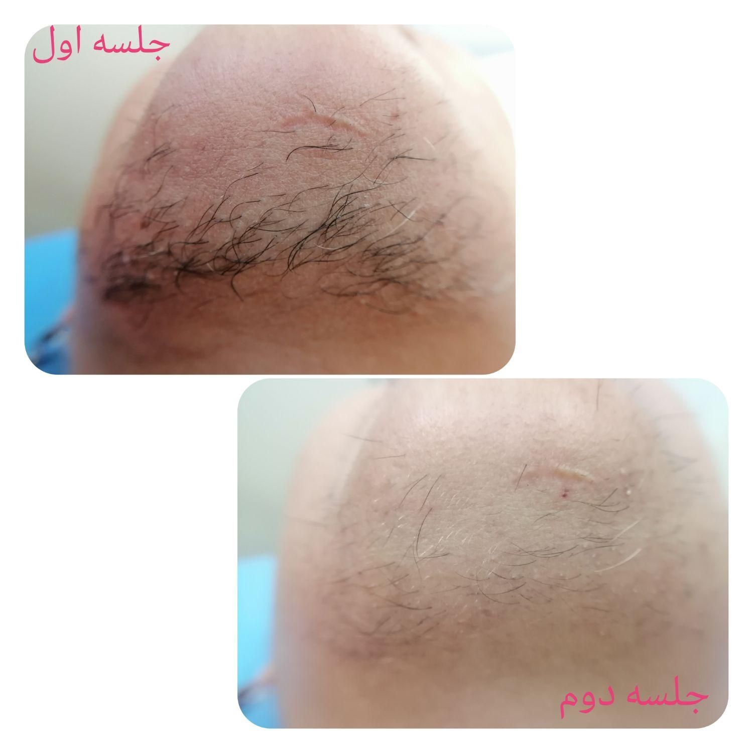 الکترولیز بانوان (رفع دائمی موهای زائد صورت و بدن)|خدمات آرایشگری و زیبایی|شیراز, گویم|دیوار