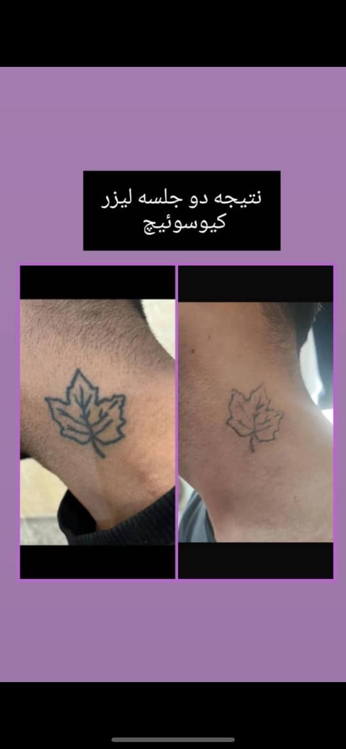 پاک کردن تتوخالکوبی/بدن ابرو لب چشم/بوتاکس کیوسویچ|خدمات آرایشگری و زیبایی|اصفهان, عباسآباد|دیوار