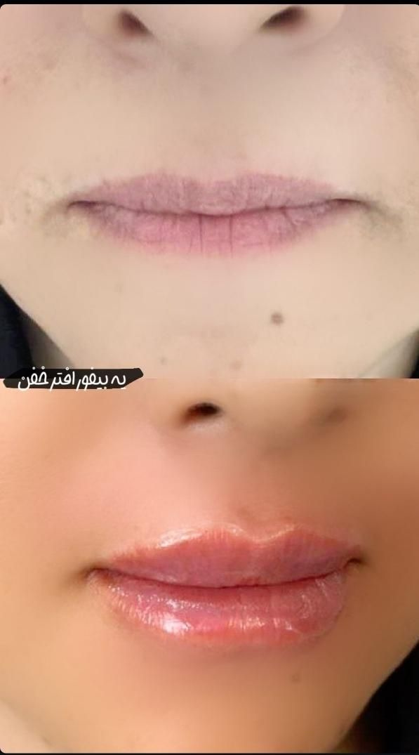 لیزر موهای زائد با قیمت باور نکردنی 550 فول بادی|خدمات آرایشگری و زیبایی|کرج, گلشهر|دیوار