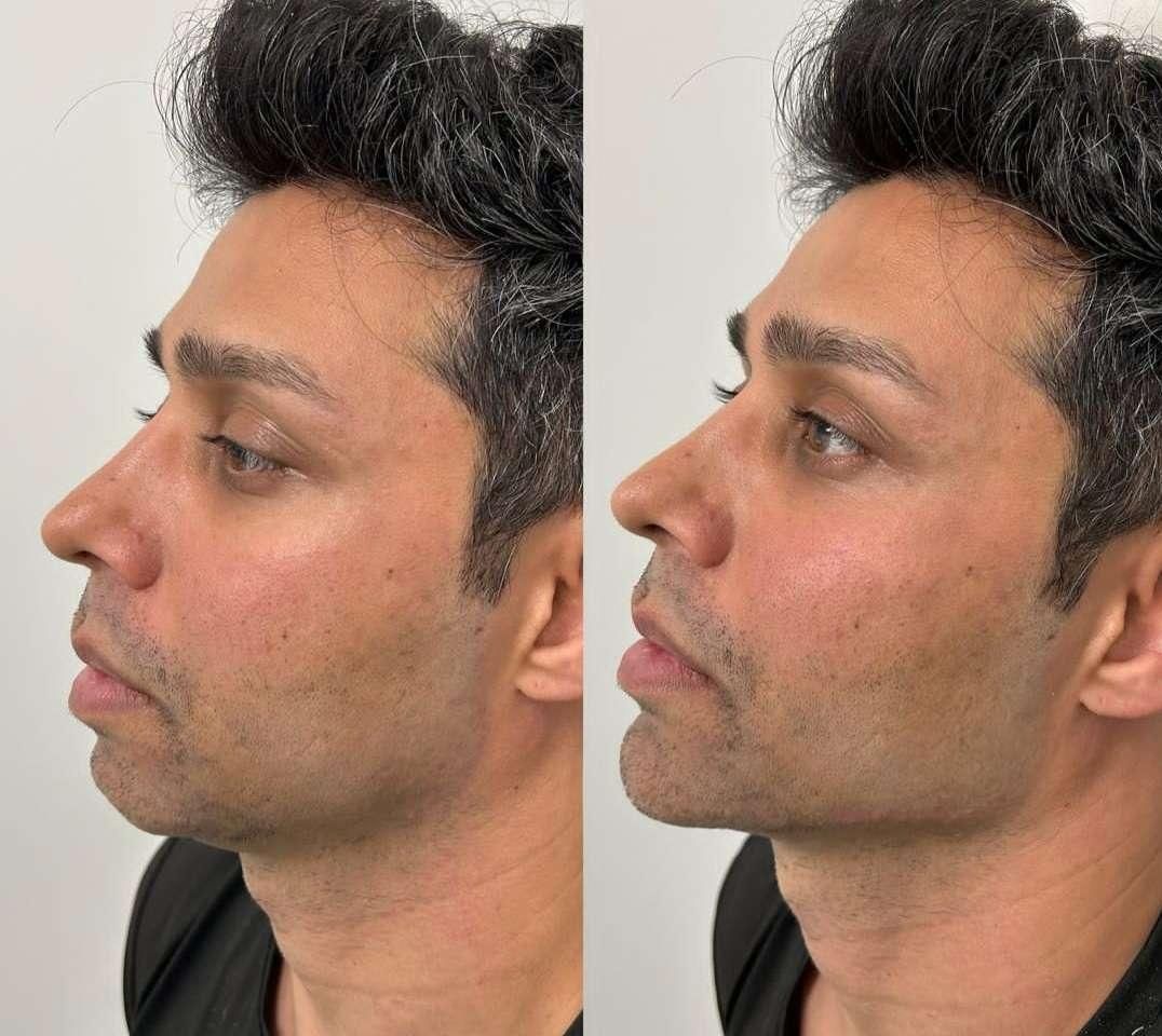 تزریق ژل و بوتاکس طراحی چهره برای زیبایی‌خاص|خدمات آرایشگری و زیبایی|تهران, شادمان|دیوار