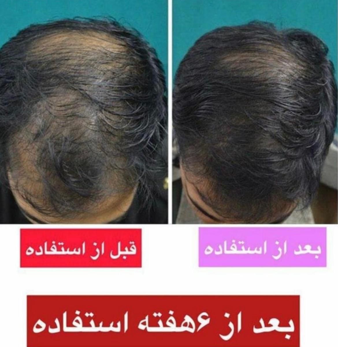 درمان قطعی ریزش مو|آرایشی، بهداشتی، درمانی|رشت, کوی جام جم|دیوار