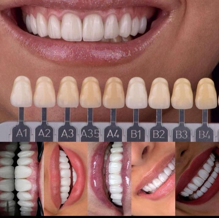 دندانپزشکی قسطی در مطب لنگرود|خدمات آرایشگری و زیبایی|لاهیجان, گلستان|دیوار