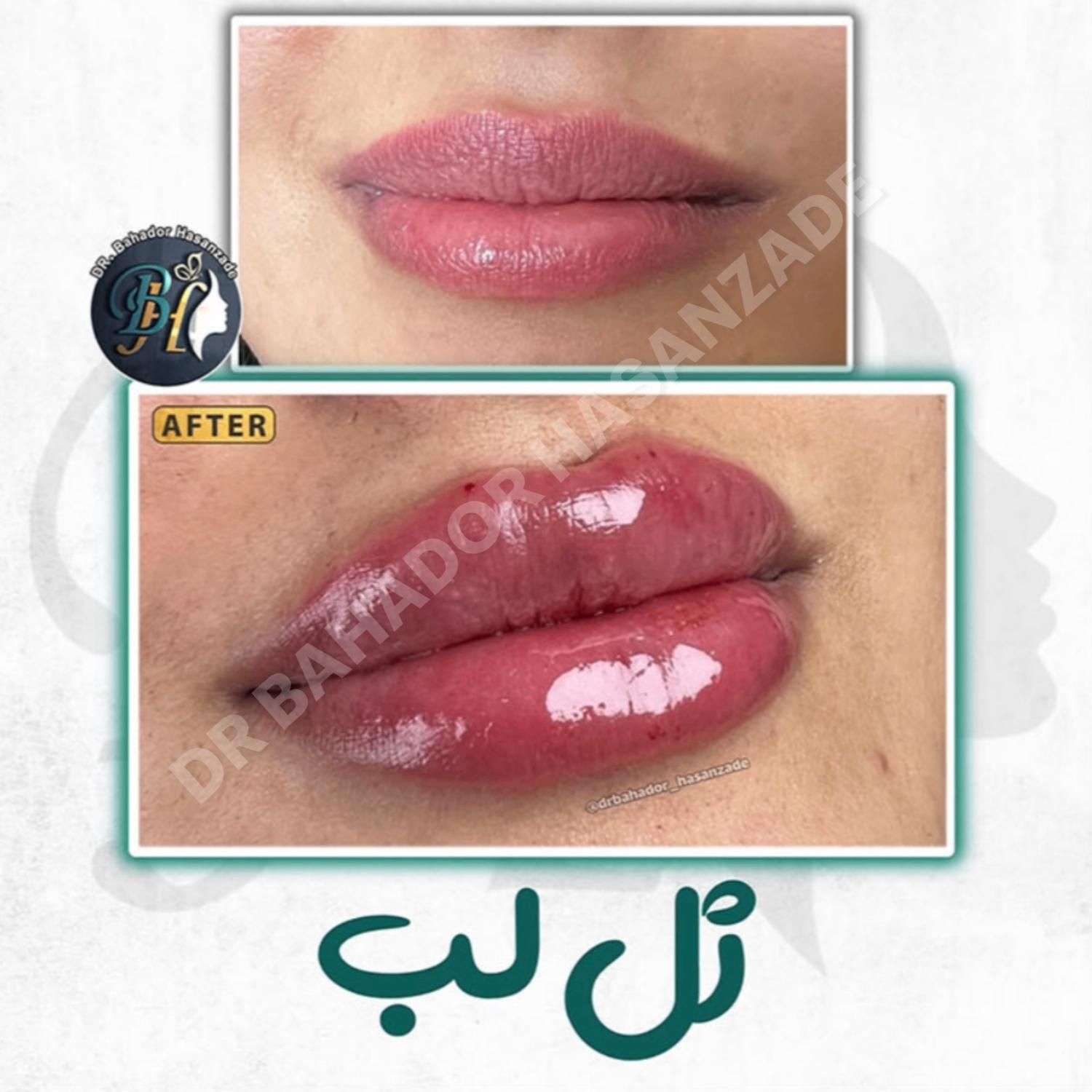 فیلر(ژل) لب گونه چانه خط خنده زاویه توسط پزشک رشت|خدمات آرایشگری و زیبایی|رشت, گلسار|دیوار